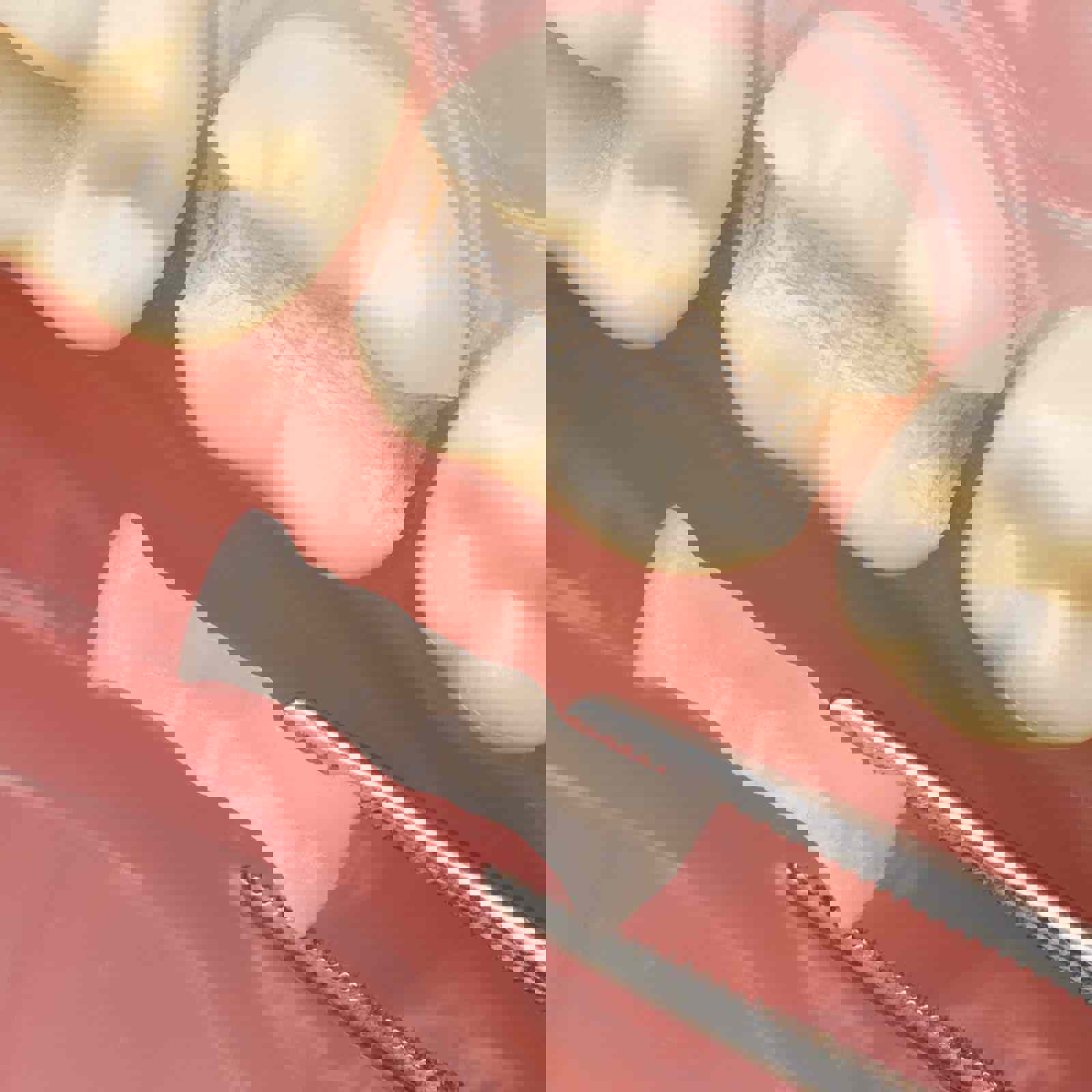 Dental filler ready to be inserted